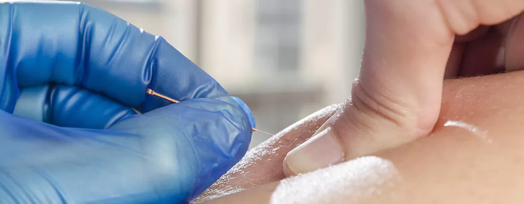 dry-needling-nebraska physical therapy